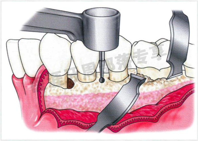 牙周外科的基本技能—翻瓣