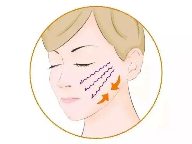 线逆向提升在线雕提升术的应用体会