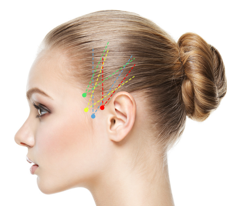 线逆向提升在线雕提升术的应用体会