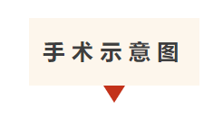 线逆向提升在线雕提升术的应用体会