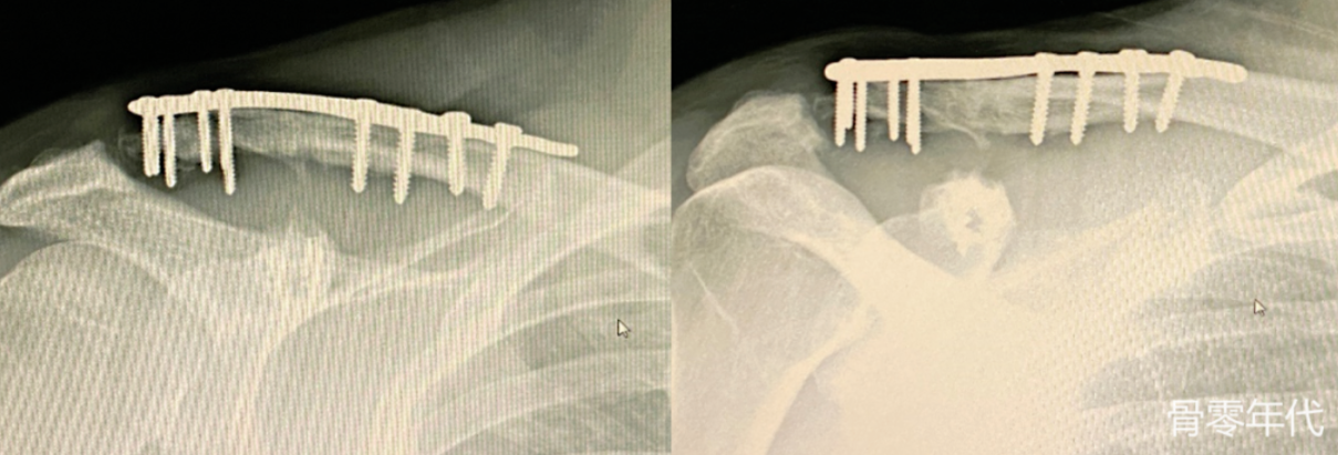 ​肩锁关节脱位伴骨折固定后的再脱位