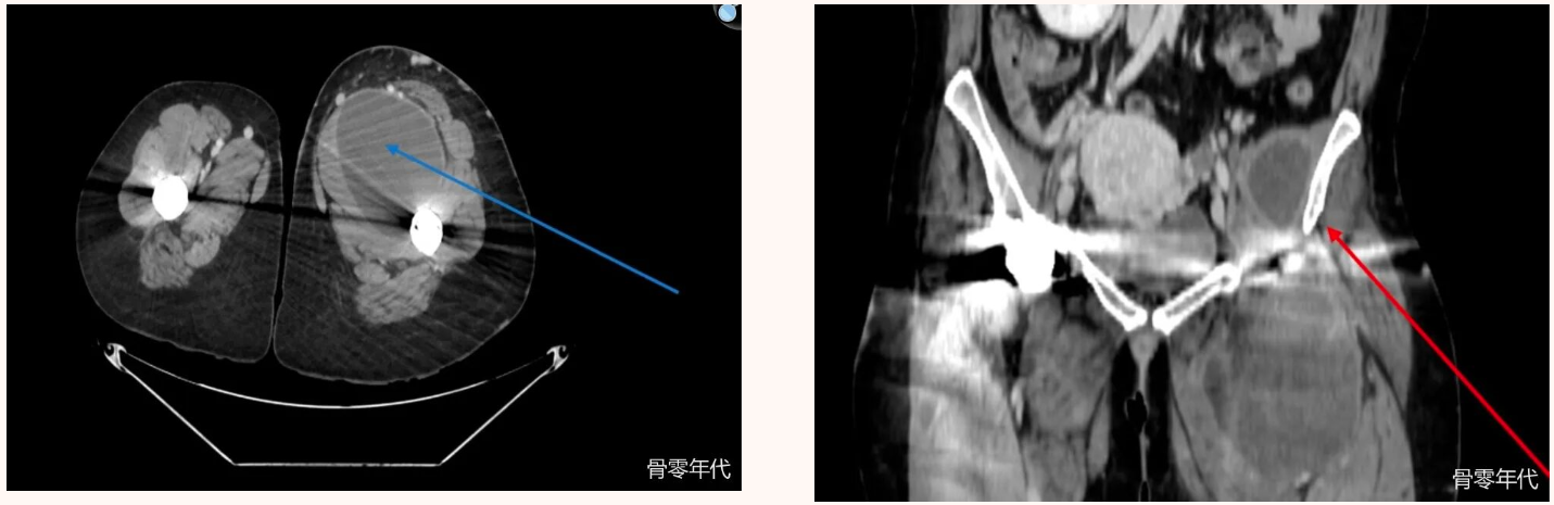 image.png 全髋关节置换术后关节周围积液的症状:是败血症还是无菌并发症?