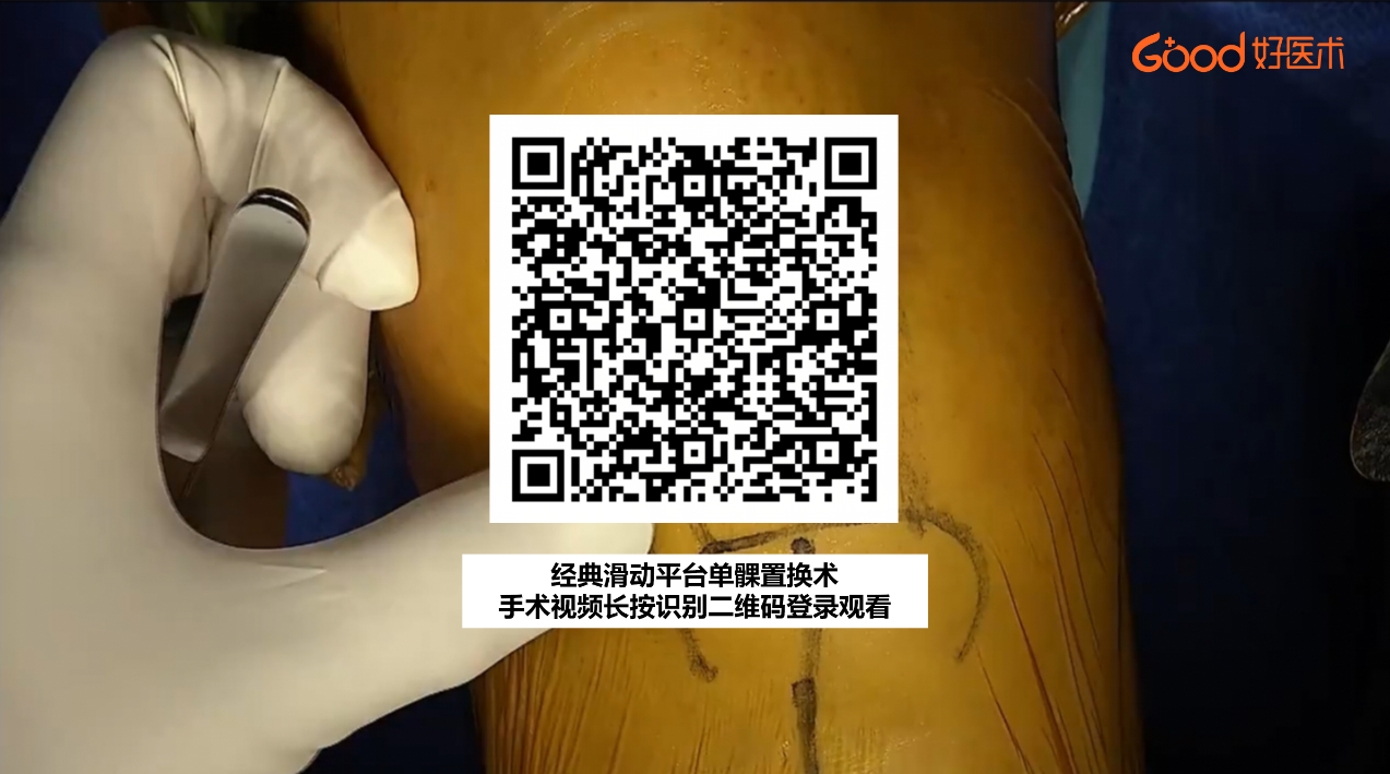 【手术视频】第一期：经典滑动平台单髁置换术